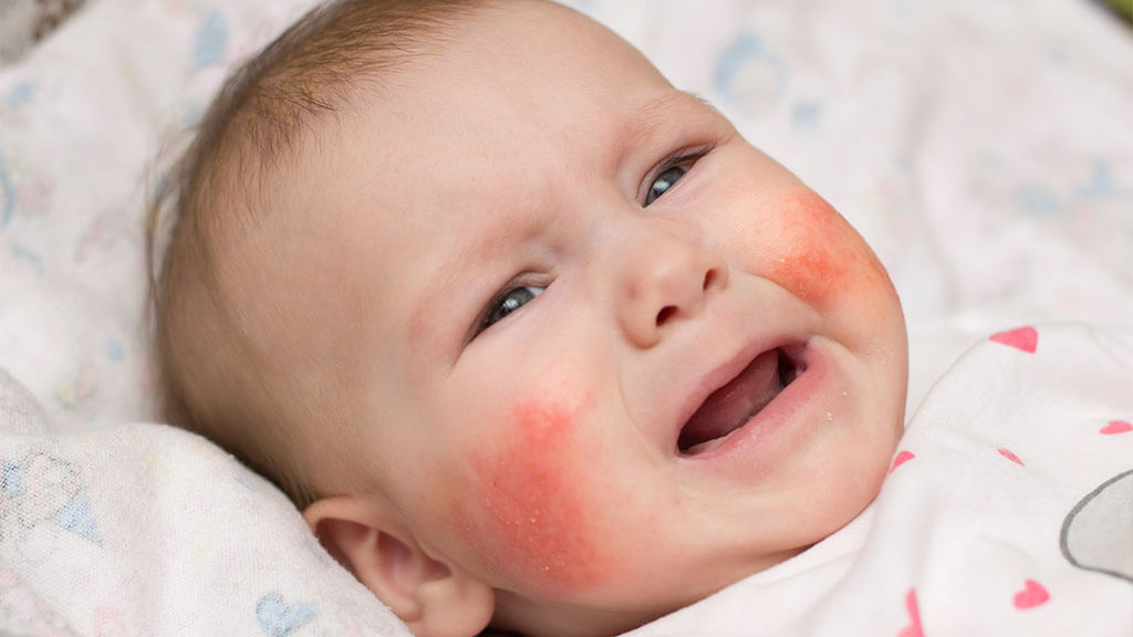 How to treat eczema in children