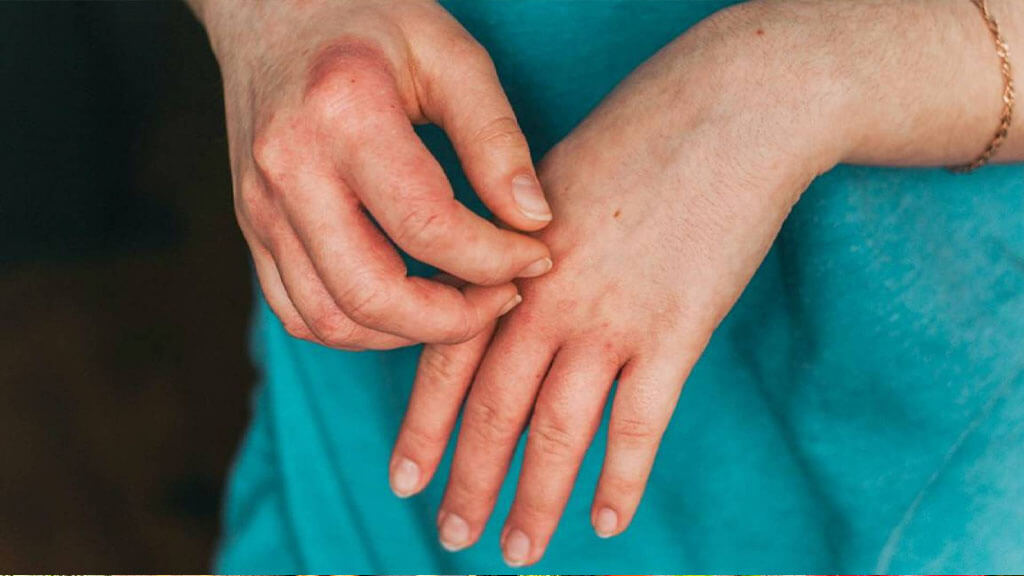 Understanding The Different Types Of Eczema