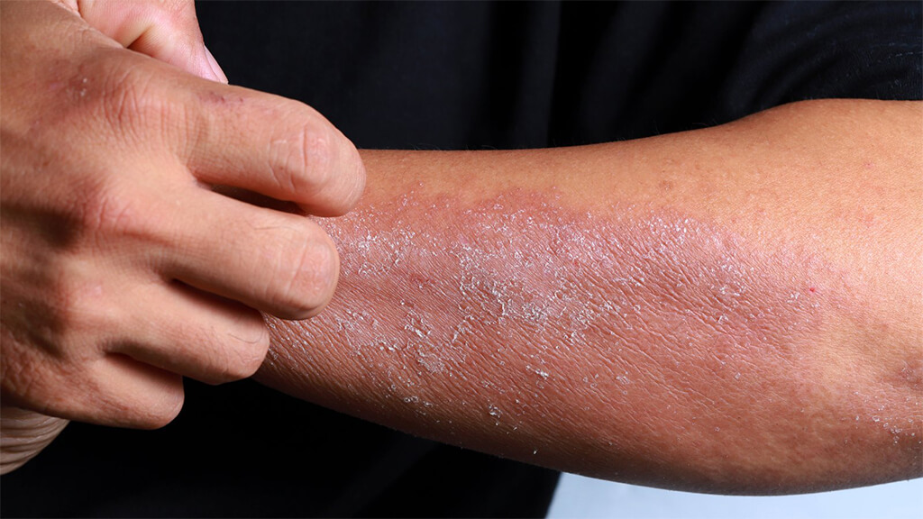 Asteatotic Eczema: Cracked Skin and Dryness Demystified ~ Eczema Free